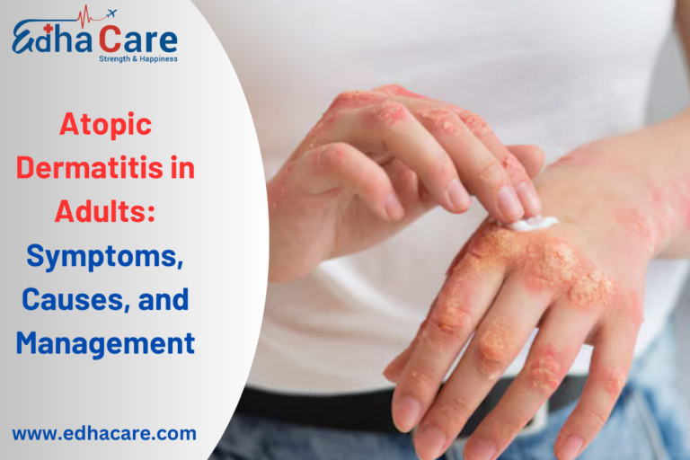 Atopic Dermatitis In Adults Symptoms And Effective Treatments