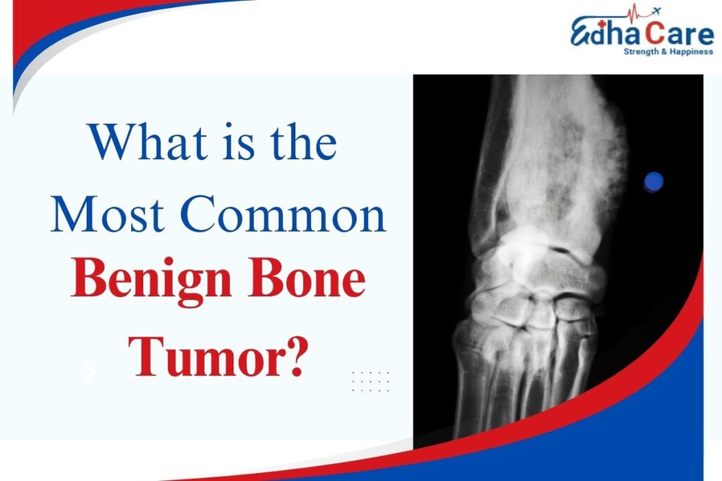 What is the Most Common Benign Bone Tumor?