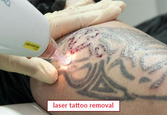 California Today Starting Over With the Help of Tattoo Removal  The New  York Times