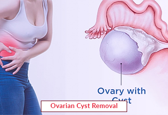Ovarian Cyst Removal - Diagnosis, Treatment