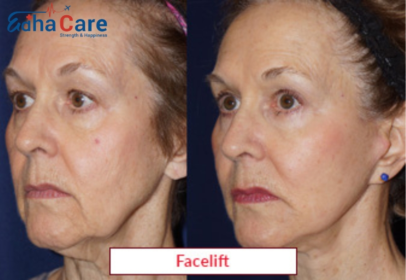 Facelift Surgery Treatment Procedure Types Risk Benefits