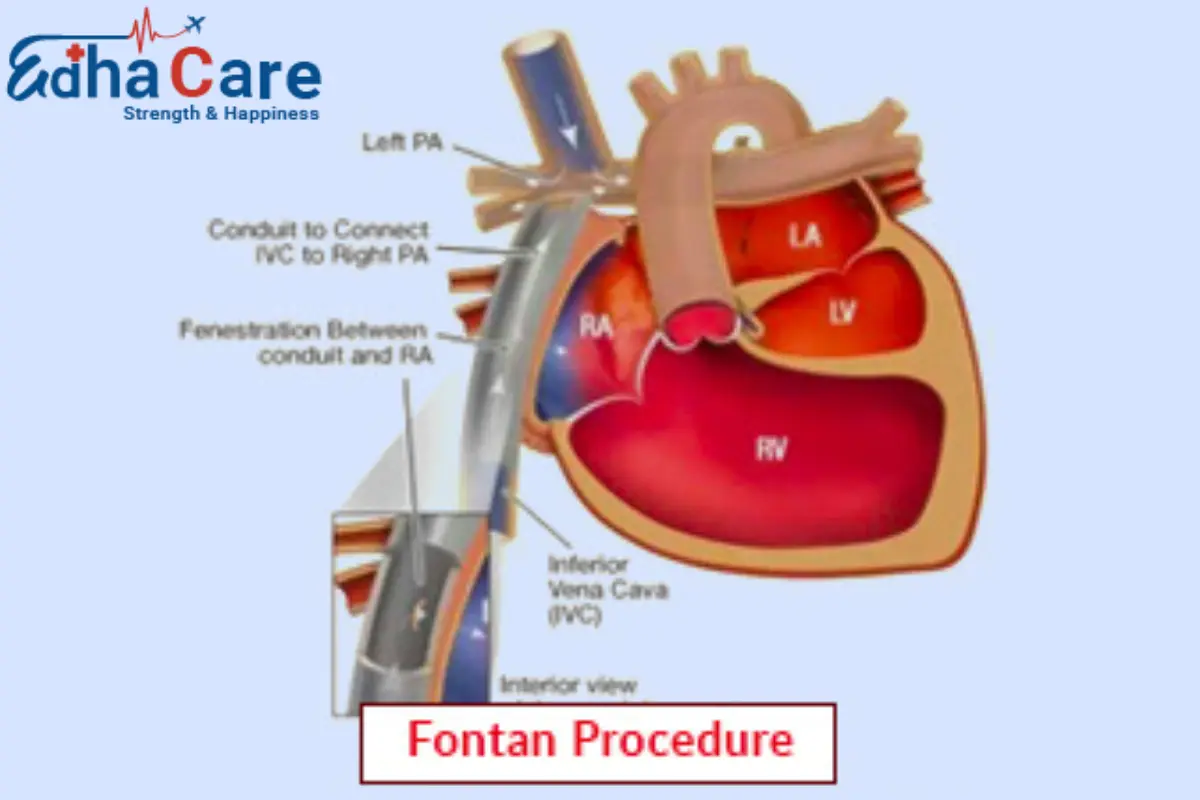 Prosedur Fontan | Bedah Fontan | Operasi Fontan | Edha Perawatan