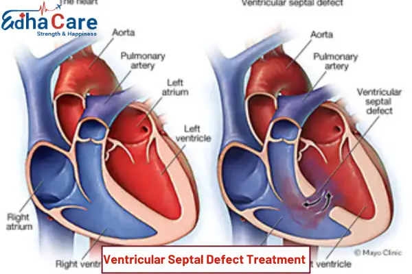 Диагностика и лечение при дефекте межжелудочковой перегородки
