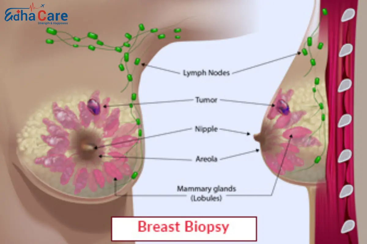 Биопсия молочной железы - Процедура и закупки | EdhaCare