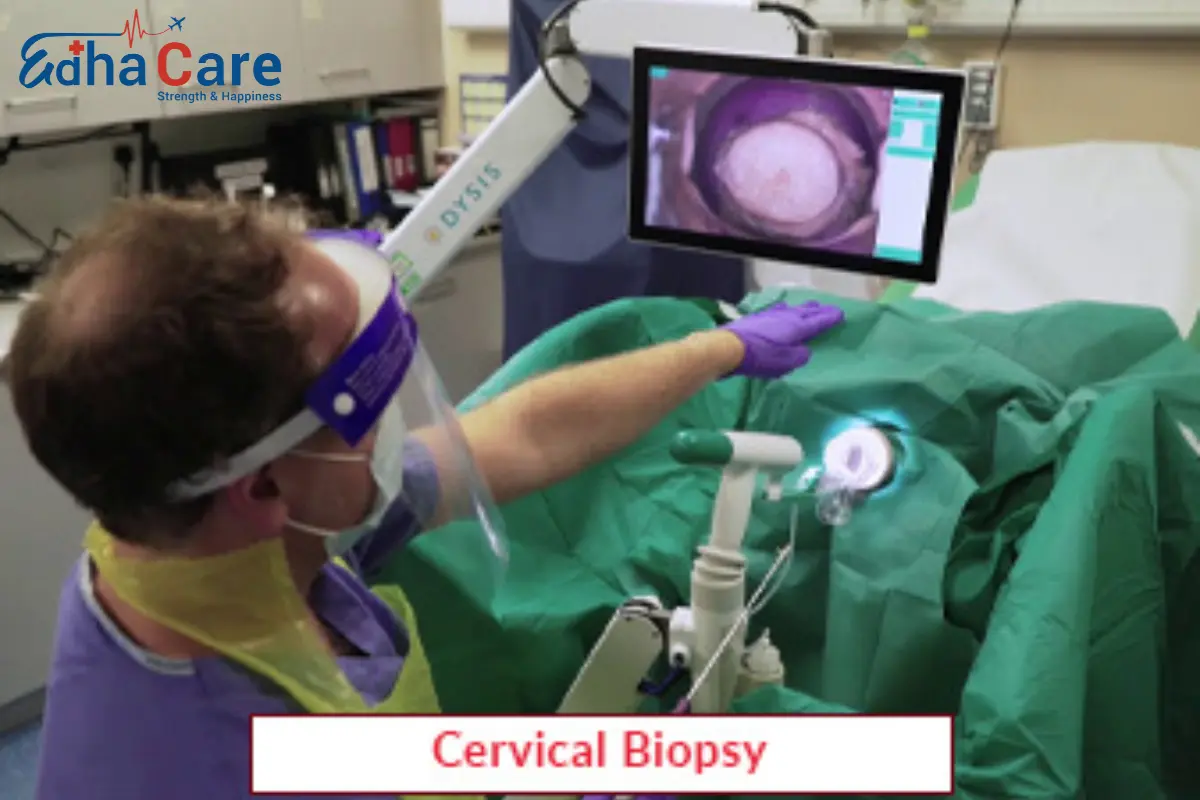 Биопсия шейки матки | процедура биопсии шейки матки | лечение шейки матки