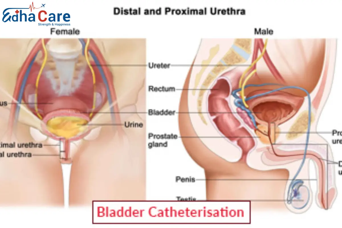 Хирургия катетеризации мочевого пузыря | Лечение катетеризации мочевого  пузыря